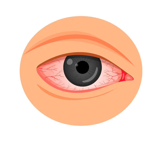 illustration of eye redness